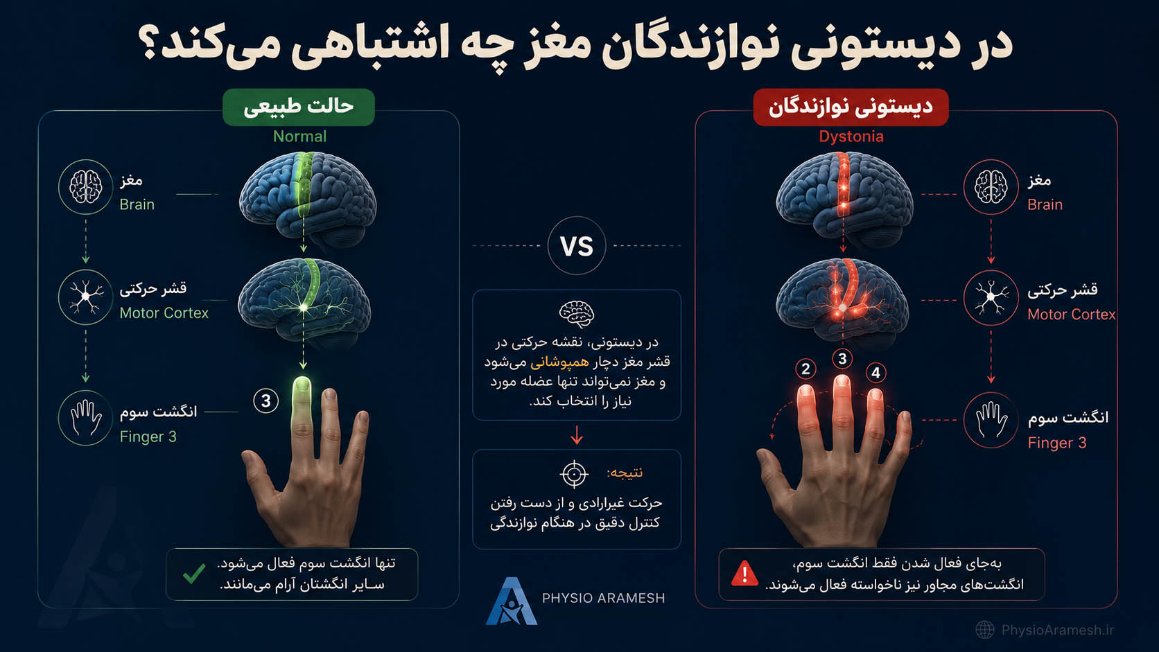 اشکال مغز در دیستونی نوازندگان